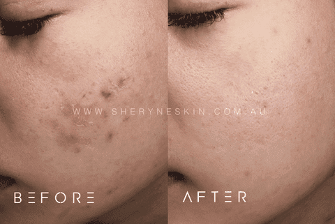 Before-and-after photos demonstrating significant improvement in post-inflammatory pigmentation on a client’s skin at Sheryne Skin Clinic. The ‘before’ image shows visible dark spots and uneven skin tone due to acne, while the ‘after’ image reveals a clearer, more even-complexioned skin after treatment.
