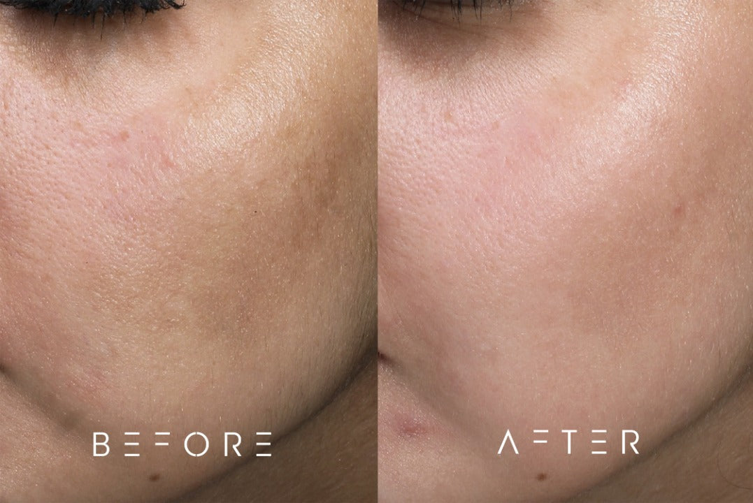 Before and after images of a HydraFacial treatment, showcasing a noticeable improvement in skin texture and clarity. The 'before' photo displays a complexion with dullness and uneven tone, while the 'after' photo reveals a radiant, smooth, and hydrated skin surface, demonstrating the effective rejuvenation capabilities of HydraFacial
