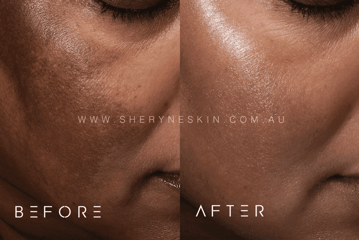 Cosmelan Peel - Sheryne Skin