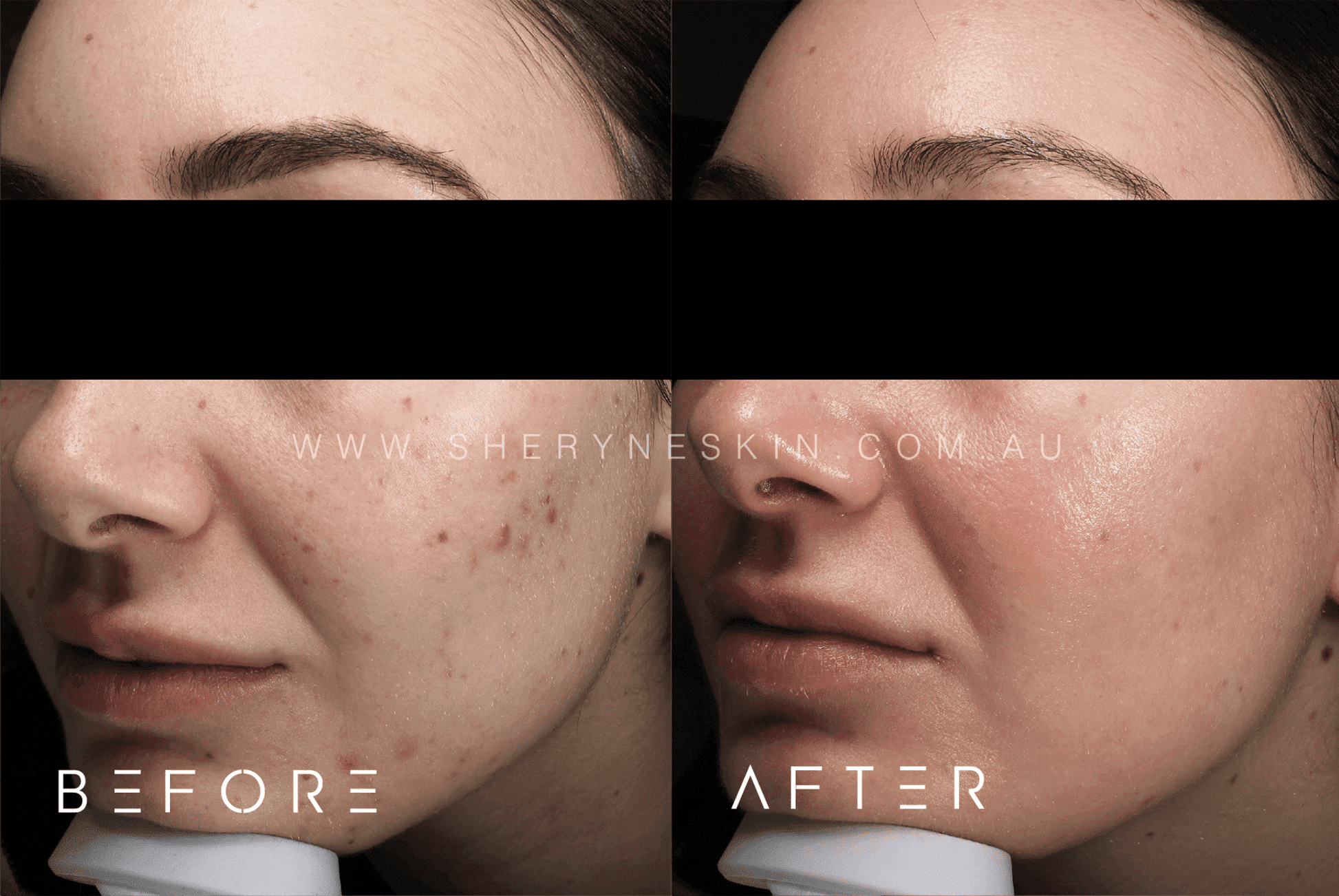 Before-and-after images showing a dramatic improvement in acne treatment at Sheryne Skin Clinic. The ‘before’ photo displays extensive acne, with redness and blemishes visible on the skin. The ‘after’ photo reveals significantly clearer skin, with a reduction in inflammation and blemishes, highlighting the effectiveness of the acne treatment provided.
