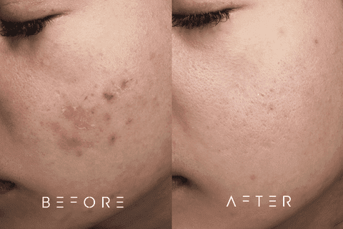Before-and-after images showing a dramatic improvement in acne treatment at Sheryne Skin Clinic. The ‘before’ photo displays extensive acne, with redness and blemishes visible on the skin. The ‘after’ photo reveals significantly clearer skin, with a reduction in inflammation and blemishes, highlighting the effectiveness of the acne treatment provided.